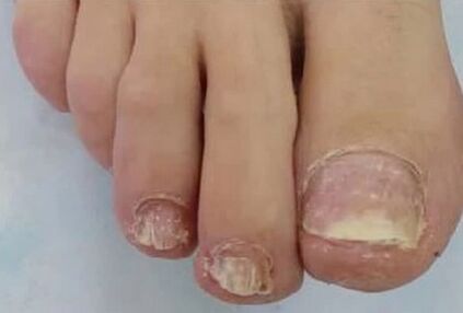 As uñas estaban moi afectadas polo fungo