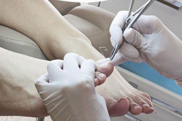 Eliminación mecánica das uñas afectadas polo fungo